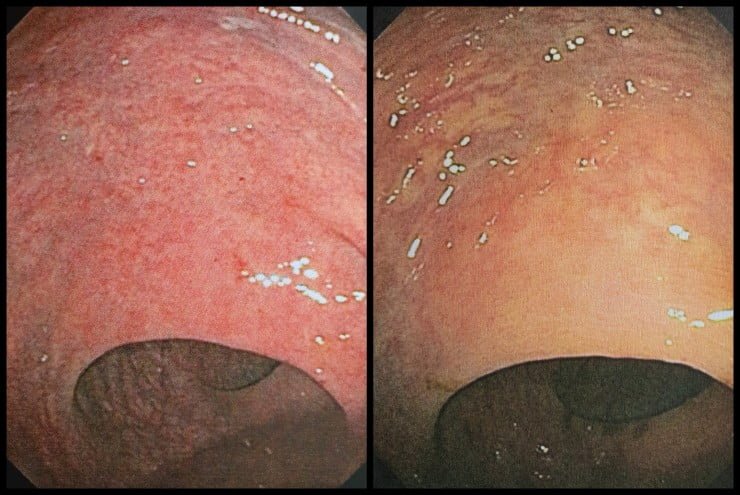 Distal rectum on colonoscopy on February 20, 2018 (left) and July 15, 2020 (right)